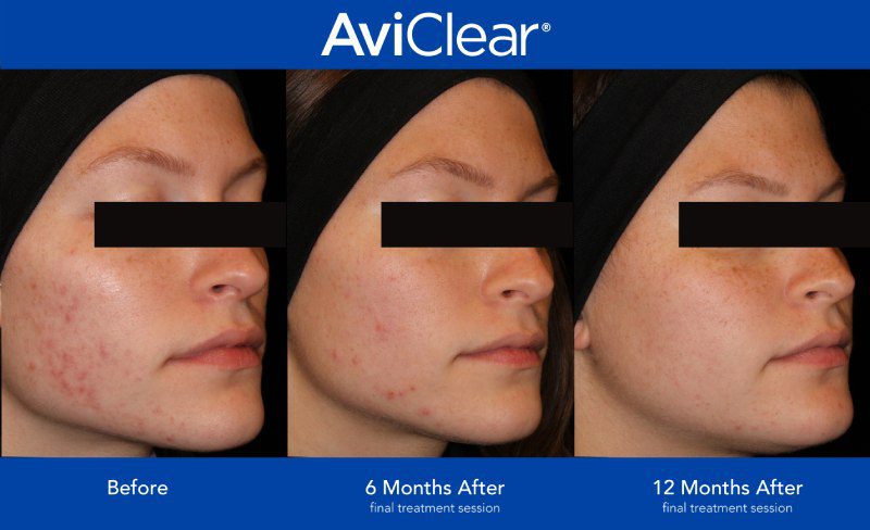 AviClear Before and After Template (6-12 mo) - 007-13-JD (R) AviClear Before and After