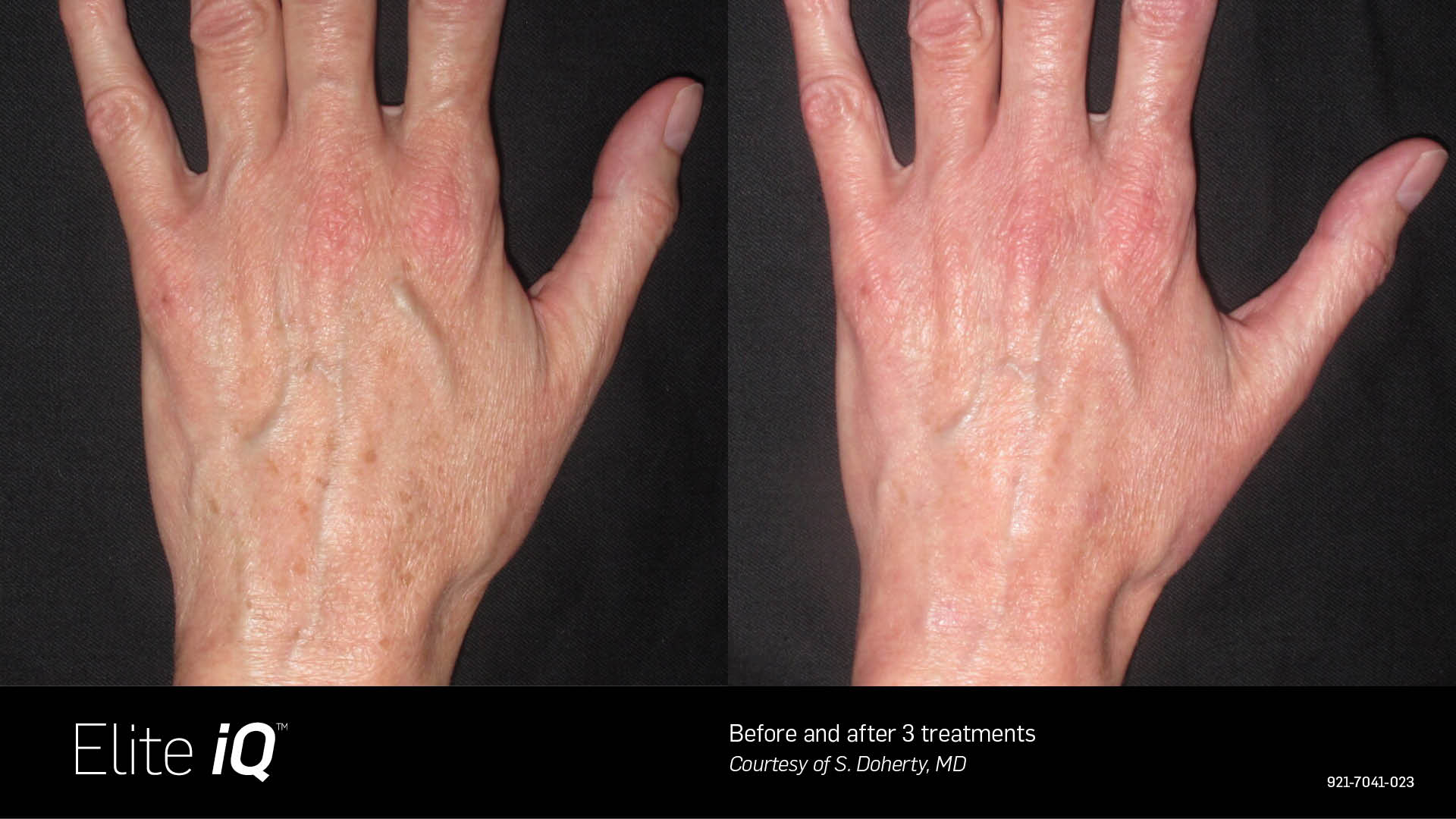 BA 005 Before and after 4 treatments
