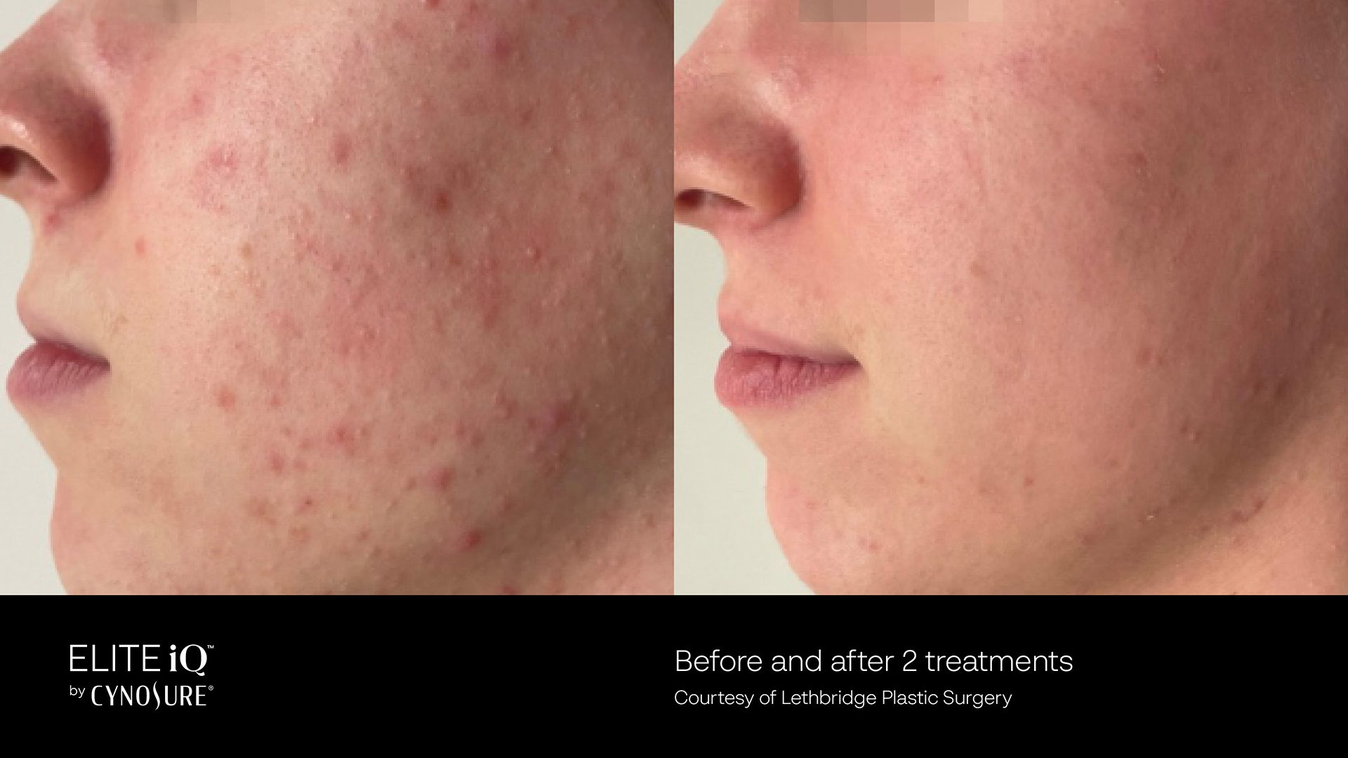 PRD-0844-Elite-iQ-BNAs-USA-EN_01 Before and after 4 treatment